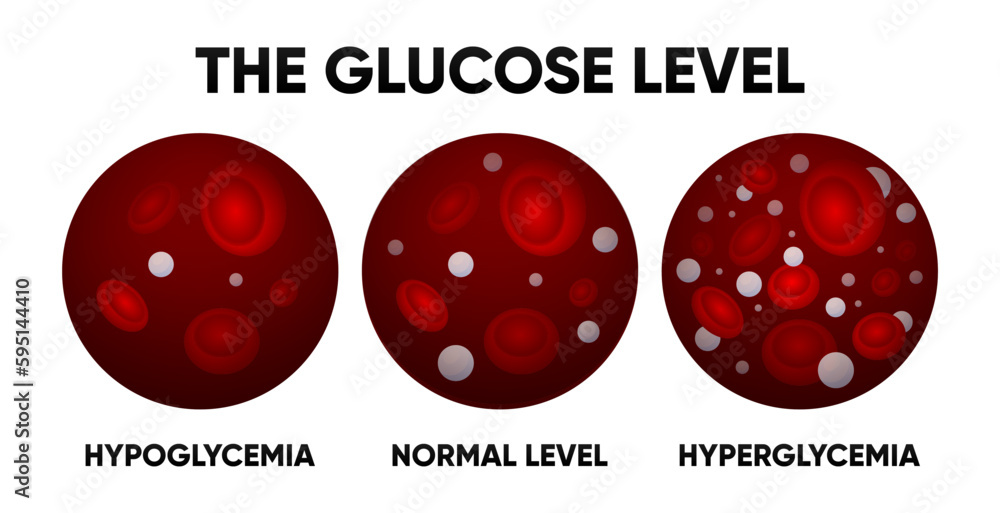 Normal Rbs Hypogly Glucose in the blood vessel. Normal levels, hyperglycemia, hypoglycemia ...