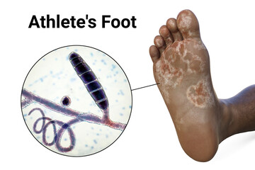 Sticker - The foot with mycosis, and close-up view of fungi that cause Athlete's foot, 3d illustration