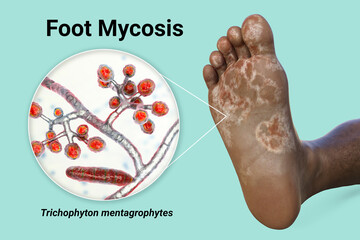 Sticker - The foot with mycosis, and close-up view of fungi that cause Athlete's foot, 3d illustration