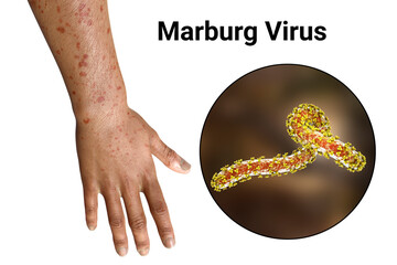 Poster - A skin rash on the arm of a patient with Marburg hemorrhagic fever and close-up view of the virus, 3D illustration