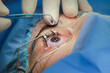 © Oktay - ophthalmology eye surgery excimer laser
