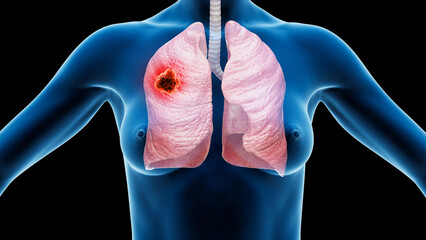 Wall Mural - 3d rendered medical illustration of lung cancer