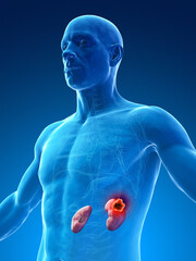 Poster - 3D Rendered Medical Illustration of Male Anatomy - Kidney Cancer.