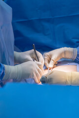 Wall Mural - Team of doctor and surgeon or nurse did appendectomy surgery inside operating room in hospital.People in blue uniform with dramatic dark background.Medical team with glove and instrument.