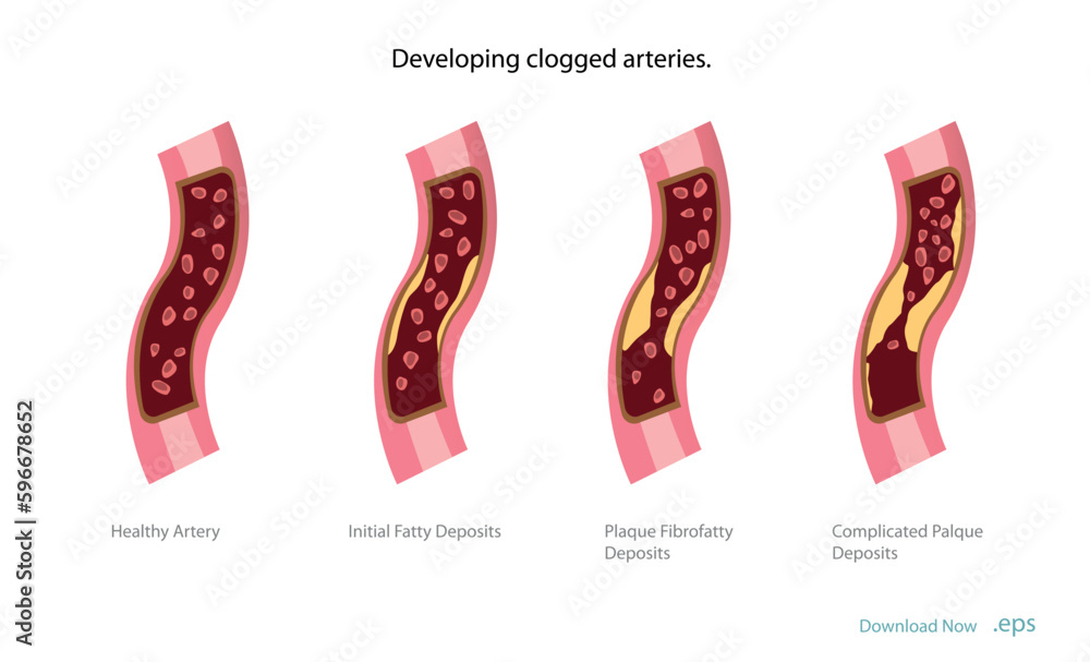 Cholesterol deposits (plaques) in the heart arteries and inflammation ...