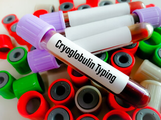 Wall Mural - Blood sample for Cryoglobulin Typing Test.