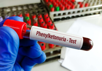 Sticker - Blood sample for Phenylketonuria (PKU) test, is an inherited disorder of that increases the levels of phenylalanine in the blood of newborn baby.