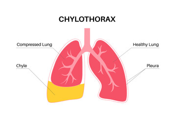 Canvas Print - Chylothorax anatomical poster