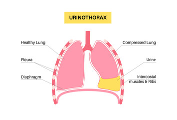 Canvas Print - Urinothorax anatomical poster