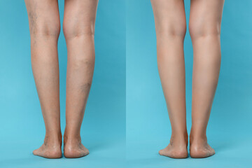 Wall Mural - Before and after varicose veins treatment. Collage with photos of woman showing legs on light blue background, closeup