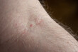 © Octavian - Small mark left by the needle on the elbow pit of a Caucasian male arm. Close up shot, unrecognizable person.