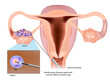 IVF Egg Retrieval technique. Egg retrieval procedure before in vitro fertilization.