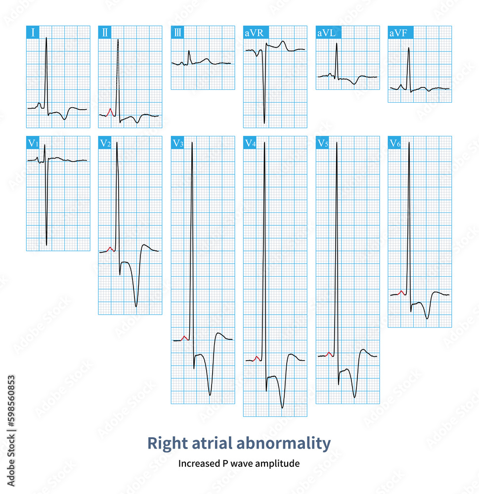 Female, 46 years old, clinically diagnosed with apical hypertrophic ...