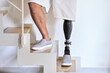 Man amputee with prosthetic leg disability on above knee transfemoral leg prosthesis artificial device stands on feet on stairs, close up. People with amputation disabilities everyday life.