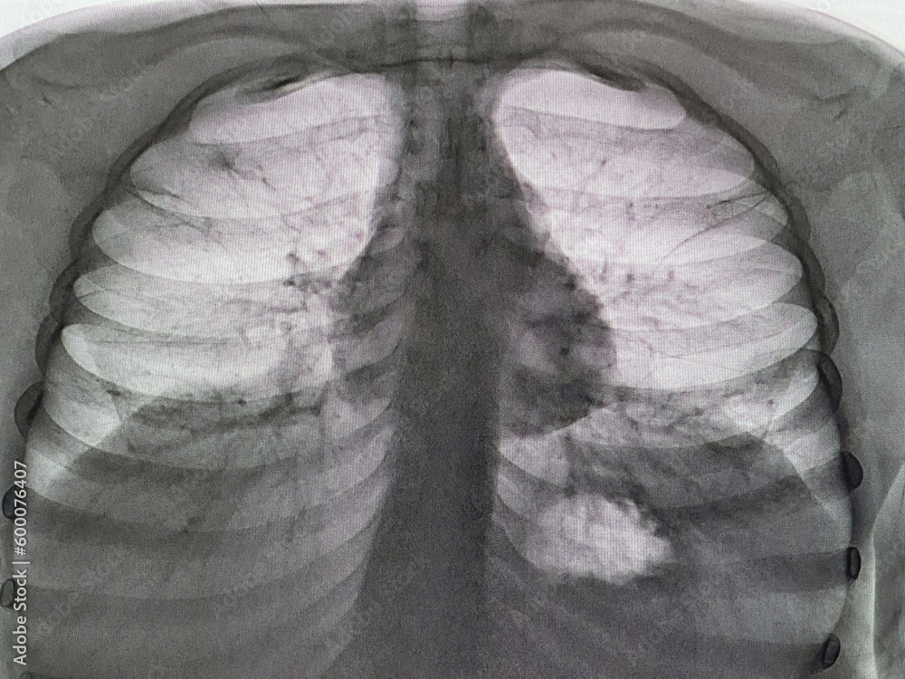 My Chest X Ray Showed A 1 Centimeter Mark Stock Photo Adobe Stock My chest x ray showed a 1 centimeter mark stock photo adobe stock