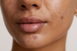 Close-up of woman face with acne