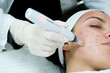 Closeup view of woman having microneedling procedure applied on her face. Microneedling. Dermapen. Esthetician. Health and beauty. 