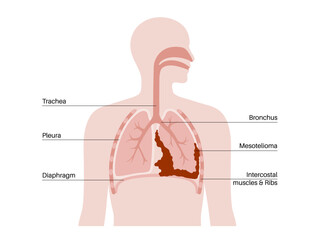 Sticker - Mesothelioma cancer disease