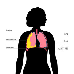 Poster - Mesothelioma cancer disease