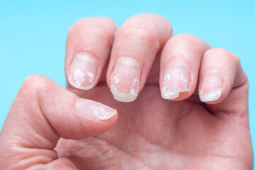 Wall Mural - Flaky bitten and brittle nails without a manicure. Regrown nail cuticle and damaged nail plate after gel polish on blue background.