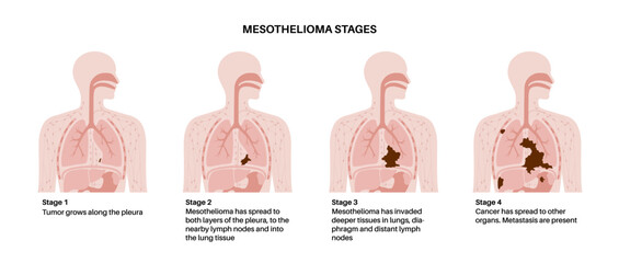 Canvas Print - Mesothelioma cancer stages