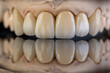 Dental health care. Ceramic zirconium in final version. Close up dental zircon ceramic crowns on black background