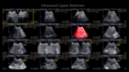 Sticker - Ultrasound upper abdomen showing  Liver and gall bladder for screening hepatic cell carcinoma and gallstone.