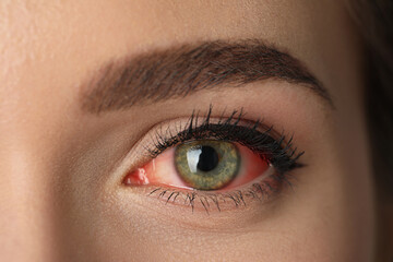 Poster - Woman suffering from conjunctivitis, closeup of red eye