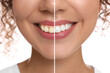 © New Africa - Photo of woman divided in halves before and after tooth whitening on white background, closeup. Collage design