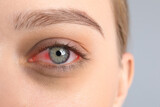 Fototapeta Panele - Woman suffering from conjunctivitis on grey background, closeup of red eye