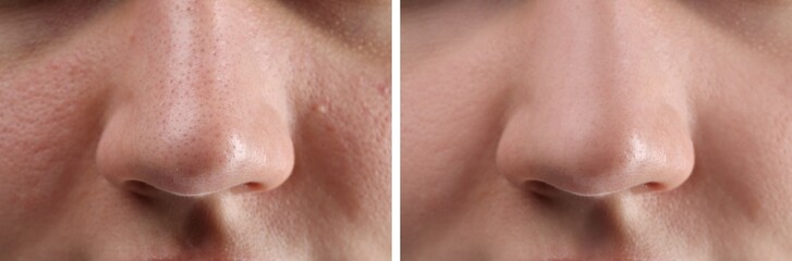 Photos of woman before and after acne treatment, closeup. Collage showing affected and healthy skin