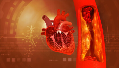 Wall Mural - Blocked blood vessel, artery with human heart anatomy. 3d illustration