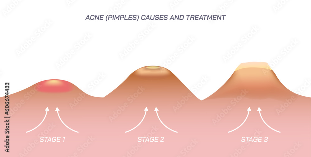 Module Pimple Skin Pimples and acne vector illustration. Appearance of the different ...