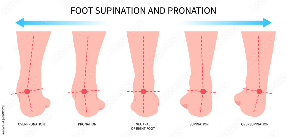 medial tibial stress syndrome knee toe or Pronation supination inward ...
