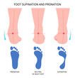 Pronation supination inward roll Feet over and Achilles Lower high fallen laxity Obesity hollow excessive of Patellofemoral tendon ligament medial tibial stress syndrome knee toe athletes sport
