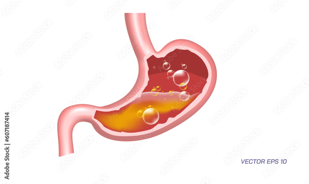 Human stomach problems, Gastrointestinal diseases. Common Digestive ...