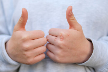 Hand with wart man skin closeup hands of young teenage girl are strewn with warts a lot of papillomas viral infection on hands touch scratching consider near nail viral infection give a thumbs up