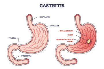 Poster - Gastritis as stomach lining inflammation illness and disease outline diagram. Labeled educational gastric problem with burning and pain in intestinal tract vector illustration. Medical structure.