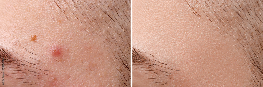 Collage with photos of man with acne problem before and after treatment ...