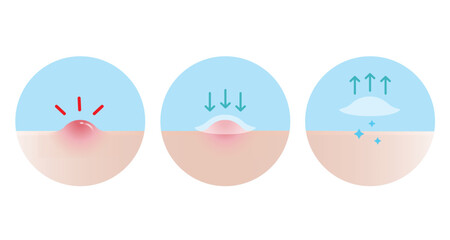 how to use acne pimple patch for inflammatory acne vector icon set illustration on white background.