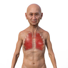 Sticker - A 3D illustration showcasing the upper half part of a man with transparent skin, revealing the lungs affected by miliary tuberculosis