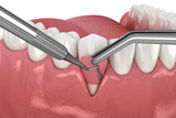 Fototapeta Kosmos - Gingiva Recession: Soft tissue graft surgery. 3D illustration of Dental  treatment