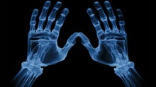 X-ray Of Both Hands Of A Male Human, Blue Tone Radiograph On A Black Background, Ai Generative
