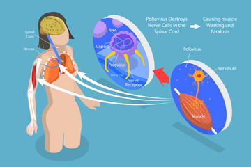 3D Isometric Flat Vector Conceptual Illustration of Poliomyelitis, Labeled Medical Virus Infection Symptoms Explanation scheme