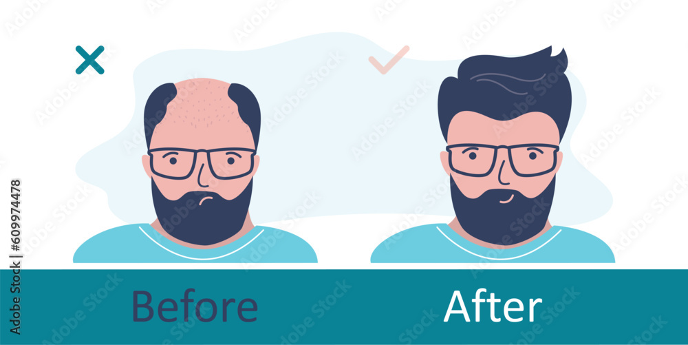 Bald man before and after hair transplantation. Unhappy person with