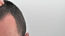 Closeup Of Man Standing In Front Of A Mirror And Looking At His Thinning Hair, Scalp Problems.