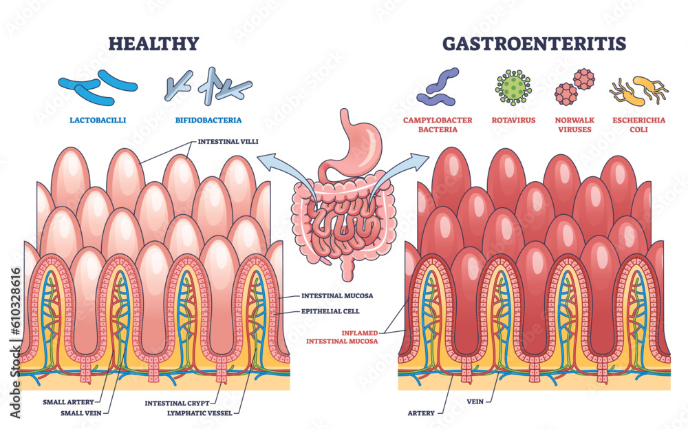 Vector De Stock Gastroenteritis Or Stomach Flu Microbiological Vector De Stock Gastroenteritis Or Stomach Flu Microbiological