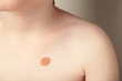 Big mole. Birthmark on body of a child.