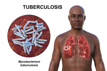 Canvas Print - A 3D illustration of the upper half of a man with transparent skin, showcasing the lungs affected by cavernous tuberculosis, and close-up view of Mycobacterium tuberculosis bacteria