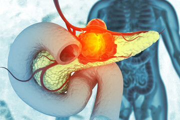 Pancreatic cancer is cancer that forms in the cells of the pancreas. 3d illustration